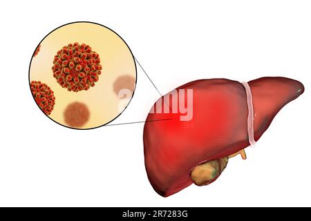 Fegato con epatite e vista ravvicinata di epatite B Virus, illustrazione. Foto Stock