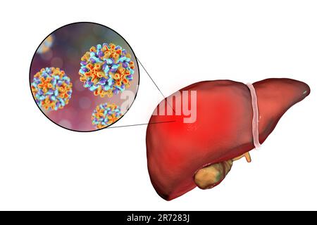 Fegato con epatite e vista ravvicinata di epatite B Virus, illustrazione. Foto Stock