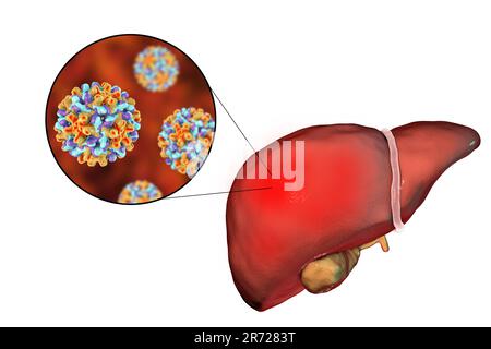 Fegato con epatite e vista ravvicinata di epatite B Virus, illustrazione. Foto Stock