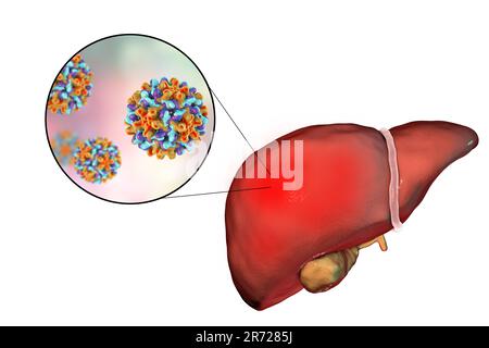 Fegato con epatite e vista ravvicinata di epatite B Virus, illustrazione. Foto Stock