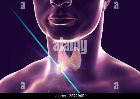 Distruzione del tumore della tiroide, illustrazione del computer. Immagine concettuale per noduli tiroidei e trattamento del cancro. Foto Stock