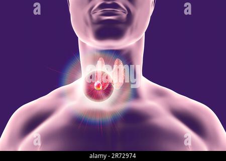 Distruzione del tumore della tiroide, illustrazione del computer. Immagine concettuale per noduli tiroidei e trattamento del cancro. Foto Stock