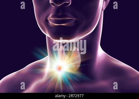 Distruzione del tumore della tiroide, illustrazione del computer. Immagine concettuale per noduli tiroidei e trattamento del cancro. Foto Stock