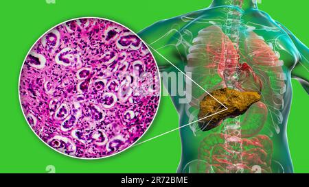 Cirrosi epatica, illustrazione computerizzata e micrografia leggera di una sezione attraverso un fegato umano che soffre di cirrosi biliare primaria. La cirrosi è Foto Stock