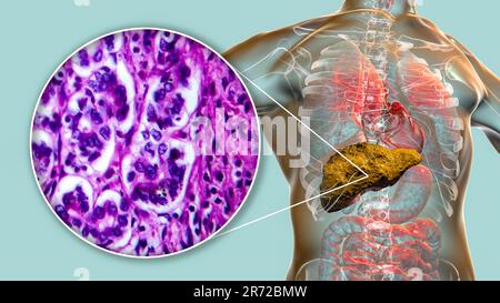 'Cirrosi epatica, computer illustrazione e micrografia leggera di una sezione attraverso un fegato umano con Foto Stock