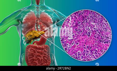 Cirrosi epatica, illustrazione computerizzata e micrografia leggera di una sezione attraverso un fegato umano che soffre di cirrosi biliare primaria. La cirrosi è Foto Stock