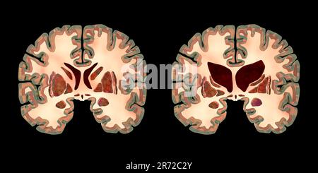 Sezioni coronali di un cervello sano e di un cervello nella malattia di Huntington che mostrano corna anteriori ingrandite dei ventricoli laterali, degenerazione e AT Foto Stock