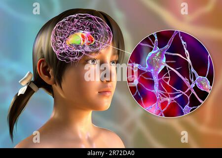 Striatum dorsale evidenziato nel cervello del bambino e vista ravvicinata dei suoi neuroni, illustrazione del computer. È un nucleo dei gangli basali, un componente Foto Stock