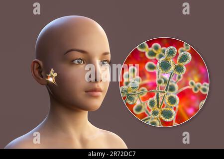 Otite fungina cronica media infezione dell'orecchio. Illustrazione del computer che mostra l'infiammazione dell'orecchio medio e vista ravvicinata dei funghi Candida albicans, t Foto Stock