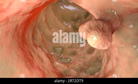 Computer illustrazione di polipi nell'intestino. I polipi sono piccole crescite benigne (non cancerose) che derivano dal rivestimento muco dell'intestino. P Foto Stock