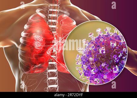 Virus Nipah nei polmoni, illustrazione concettuale del computer. Il virus Nipah è zoonotico (trasmesso agli esseri umani da animali) ed è stato trovato per la prima volta in Malesia A. Foto Stock