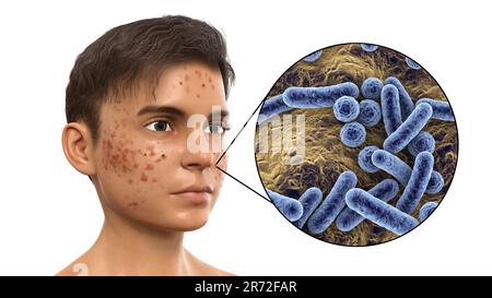 Vulgaris dell'acne sulla faccia del ragazzo dell'adolescenza e vista ravvicinata dei batteri che causano l'acne, illustrazione del calcolatore. L'acne è un nome generale dato ad un dis della pelle Foto Stock