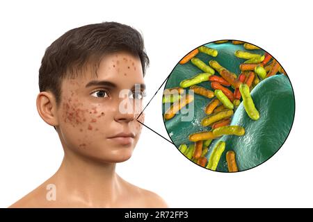 Vulgaris dell'acne sulla faccia del ragazzo dell'adolescenza e vista ravvicinata dei batteri che causano l'acne, illustrazione del calcolatore. L'acne è un nome generale dato ad un dis della pelle Foto Stock