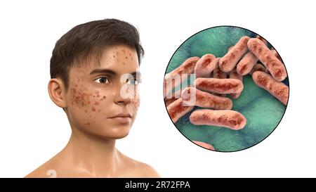 Vulgaris dell'acne sulla faccia del ragazzo dell'adolescenza e vista ravvicinata dei batteri che causano l'acne, illustrazione del calcolatore. L'acne è un nome generale dato ad un dis della pelle Foto Stock