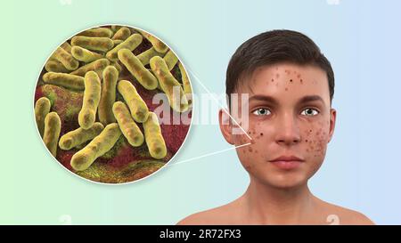 Vulgaris dell'acne sulla faccia del ragazzo dell'adolescenza e vista ravvicinata dei batteri che causano l'acne, illustrazione del calcolatore. L'acne è un nome generale dato ad un dis della pelle Foto Stock