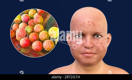 Vulgaris dell'acne sulla faccia del ragazzo dell'adolescenza in sovrappeso e vista ravvicinata dei batteri che causano l'acne, illustrazione del calcolatore. L'acne è un nome generale dato t Foto Stock