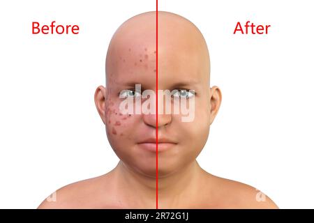 Vulgaris dell'acne sulla faccia del ragazzo dell'adolescenza in sovrappeso, illustrazione del calcolatore che mostra la pelle del ragazzo prima e dopo il trattamento. L'acne è un giv di nome generale Foto Stock