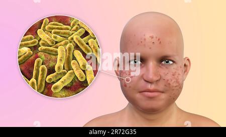 Vulgaris dell'acne sulla faccia del ragazzo dell'adolescenza in sovrappeso e vista ravvicinata dei batteri che causano l'acne, illustrazione del calcolatore. L'acne è un nome generale dato t Foto Stock