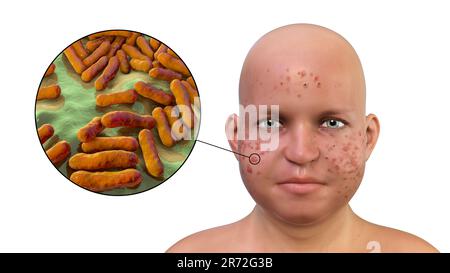 Vulgaris dell'acne sulla faccia del ragazzo dell'adolescenza in sovrappeso e vista ravvicinata dei batteri che causano l'acne, illustrazione del calcolatore. L'acne è un nome generale dato t Foto Stock