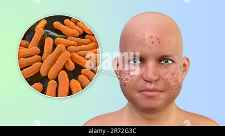 Vulgaris dell'acne sulla faccia del ragazzo dell'adolescenza in sovrappeso e vista ravvicinata dei batteri che causano l'acne, illustrazione del calcolatore. L'acne è un nome generale dato t Foto Stock