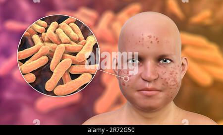 Vulgaris dell'acne sulla faccia del ragazzo dell'adolescenza in sovrappeso e vista ravvicinata dei batteri che causano l'acne, illustrazione del calcolatore. L'acne è un nome generale dato t Foto Stock