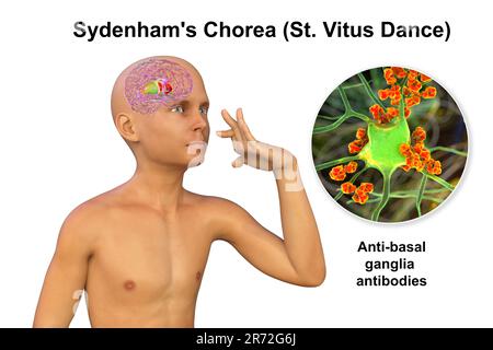 La Corea di Sydenham, una malattia autoimmune che deriva dall'infezione da Streptococco, formazione di anticorpi anti-neuronali che danneggiano i gangli basali cerebrali Foto Stock