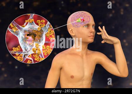 La Corea di Sydenham, una malattia autoimmune che deriva dall'infezione da Streptococco, formazione di anticorpi anti-neuronali che danneggiano i gangli basali cerebrali Foto Stock