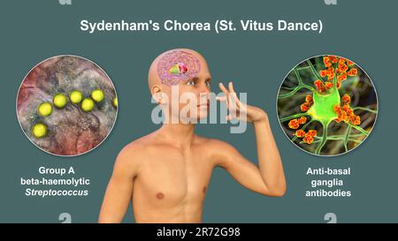 La Corea di Sydenham, una malattia autoimmune che deriva dall'infezione da Streptococco, formazione di anticorpi anti-neuronali che danneggiano i gangli basali cerebrali Foto Stock