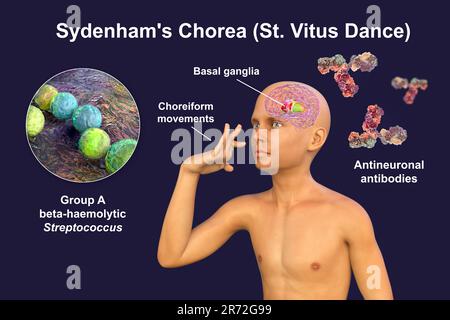 La Corea di Sydenham, una malattia autoimmune che deriva dall'infezione da Streptococco, formazione di anticorpi anti-neuronali che danneggiano i gangli basali cerebrali Foto Stock