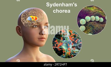 La Corea di Sydenham, una malattia autoimmune che deriva dall'infezione da Streptococco, formazione di anticorpi anti-neuronali che danneggiano i gangli basali cerebrali Foto Stock