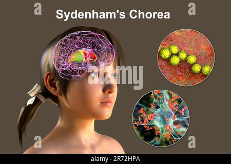 La Corea di Sydenham, una malattia autoimmune che deriva dall'infezione da Streptococco, formazione di anticorpi anti-neuronali che danneggiano i gangli basali cerebrali Foto Stock