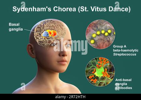 La Corea di Sydenham, una malattia autoimmune che deriva dall'infezione da Streptococco, formazione di anticorpi anti-neuronali che danneggiano i gangli basali cerebrali Foto Stock