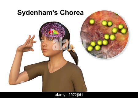 La Corea di Sydenham, una malattia autoimmune che deriva dall'infezione da Streptococco, formazione di anticorpi anti-neuronali che danneggiano i gangli basali cerebrali Foto Stock