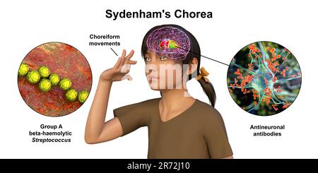 La Corea di Sydenham, una malattia autoimmune che deriva dall'infezione da Streptococco, formazione di anticorpi anti-neuronali che danneggiano i gangli basali cerebrali Foto Stock