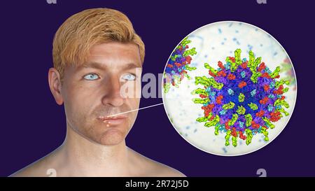 Mal di freddo sul labbro di un uomo e primo piano vista di herpes simplex virus, computer illustrazione. Le piaghe fredde sono dolorose, vescicole fluide-riempite causate Foto Stock