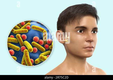 Otite media, un gruppo di malattie infiammatorie dell'orecchio medio. Illustrazione del computer che mostra un ragazzo con strutture evidenziate al centro e dentro Foto Stock