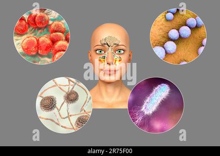 Anatomia della rinosinusite e microrganismi che causano sinusite. Streptococcus pneumoniae, Streptococcus mutans, Aspergillus fumigatus e Pseudomo Foto Stock