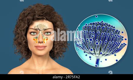Funghi Aspergillus come causa di sinusite. Illustrazione del computer che mostra infiammazione dei seni mascellari e vista ravvicinata del fungo Aspergillus. C Foto Stock