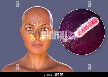 Batteri di Pseudomonas aeruginosa come causa di sinusite. Illustrazione del computer che mostra infiammazione purulenta dei seni mascellari e vista ravvicinata di Foto Stock