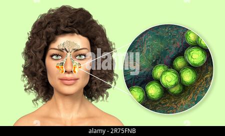 Streptococcus pyogenes batteri e altri streptococchi come causa di sinusite. Illustrazione del computer che mostra l'infiammazione dei seni mascellari in fem Foto Stock