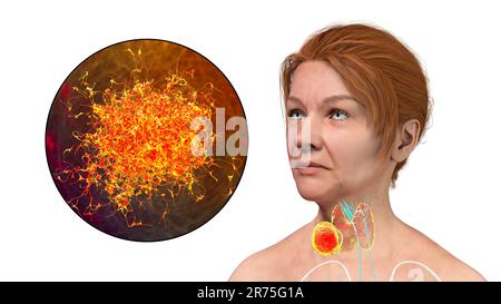 Cancro della ghiandola tiroidea con vista di closeup delle cellule tumorali, illustrazione del computer. Foto Stock