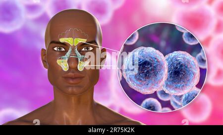 Sinusite batterica, computer illustrazione. I seni sono spazi riempiti d'aria rivestiti da membrana nelle ossa del viso. Sinusite, nota anche come sinu Foto Stock