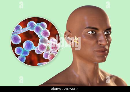 Otite fungina cronica media infezione dell'orecchio. Illustrazione del computer che mostra l'infiammazione dell'orecchio medio e vista ravvicinata dei funghi Candida albicans, t Foto Stock