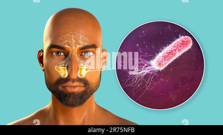 Batteri di Pseudomonas aeruginosa come causa di sinusite. Illustrazione del computer che mostra infiammazione purulenta dei seni mascellari e vista ravvicinata di Foto Stock