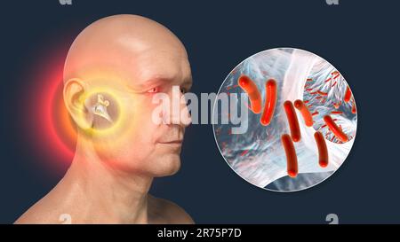 Otite media, un gruppo di malattie infiammatorie dell'orecchio medio. Illustrazione di un computer che mostra un uomo con strutture evidenziate al centro e dentro Foto Stock