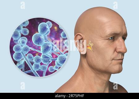 Otite fungina cronica media infezione dell'orecchio. Illustrazione del computer che mostra l'infiammazione dell'orecchio medio e vista ravvicinata dei funghi Candida albicans, t Foto Stock