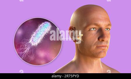 Batterio di Pseudomonas aeruginosa come causa di otite media. Illustrazione del computer che mostra l'infiammazione purulenta dell'orecchio medio in una ragazza e vicino Foto Stock