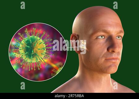 Otite virale media, un gruppo di malattie infiammatorie dell'orecchio medio. Illustrazione del computer che mostra una persona con le strutture evidenziate di infiamme Foto Stock