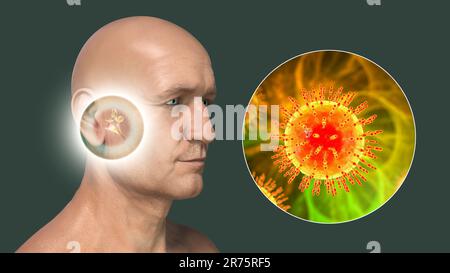 Otite virale media, un gruppo di malattie infiammatorie dell'orecchio medio. Illustrazione del computer che mostra una persona con le strutture evidenziate di infiamme Foto Stock