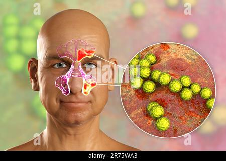 Streptococcus pyogenes batteri come causa di sinusite. Illustrazione di Comouter che mostra un'infiammazione purulenta dei seni e delle clos frontali e mascellari Foto Stock